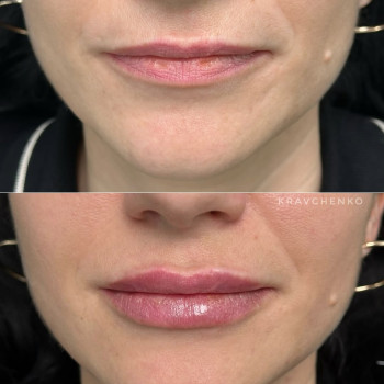 Збільшення губ філером