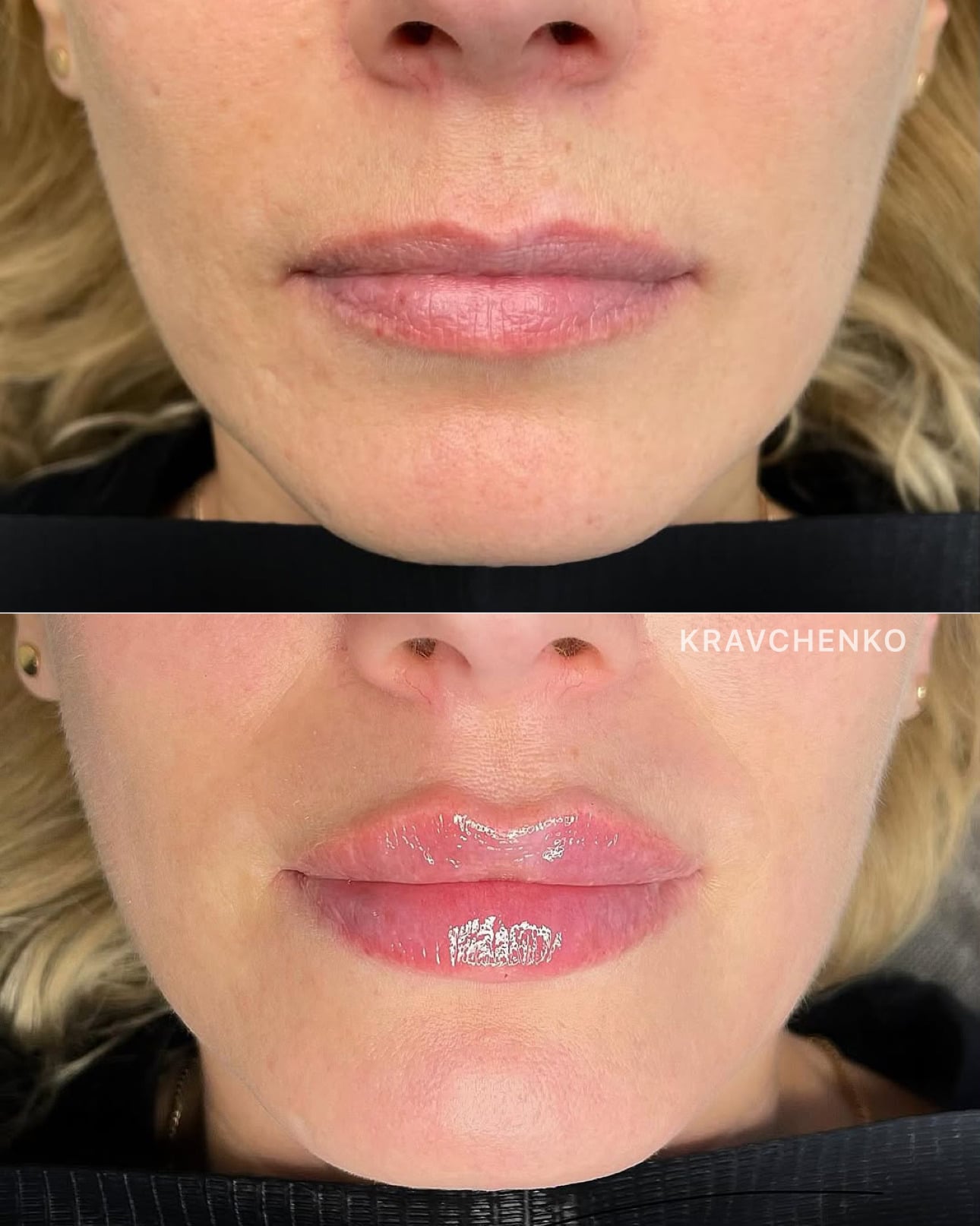 Збільшення губ філером, фото - Врач-косметолог Филипп Кравченко