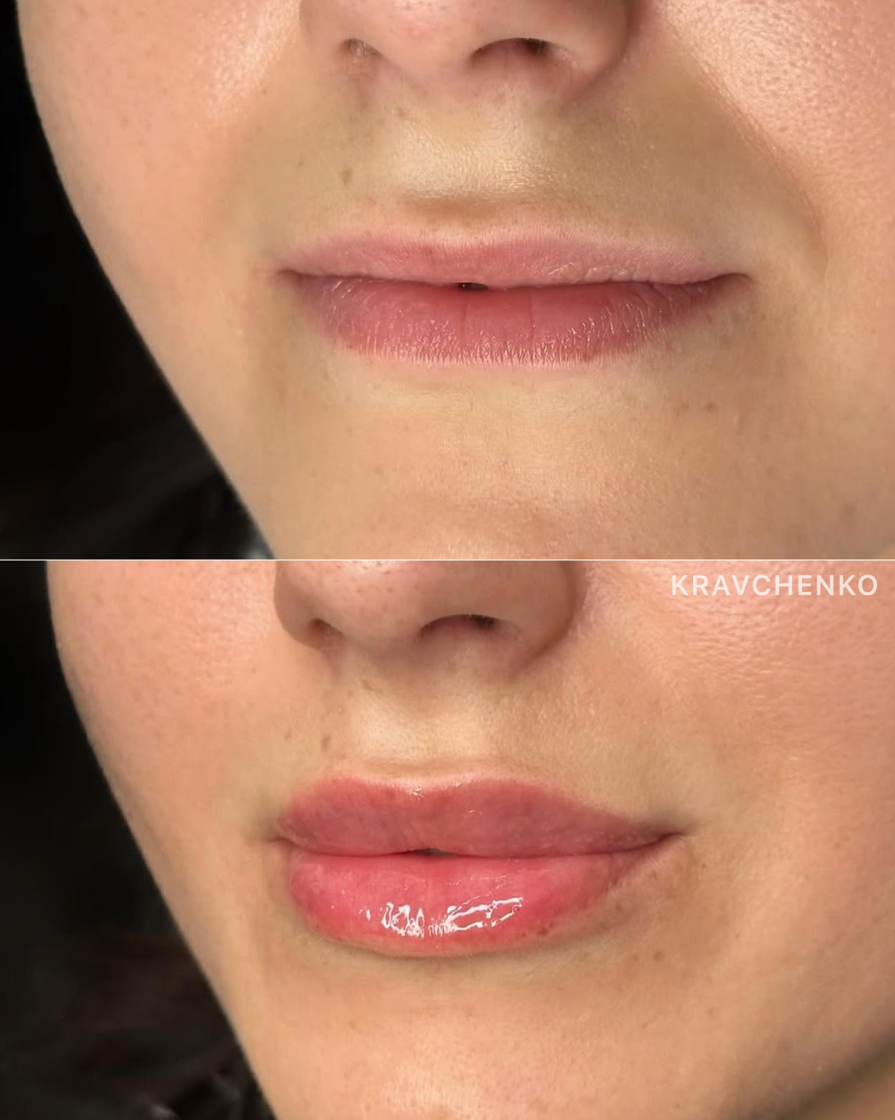 Збільшення губ філером, фото - Врач-косметолог Филипп Кравченко