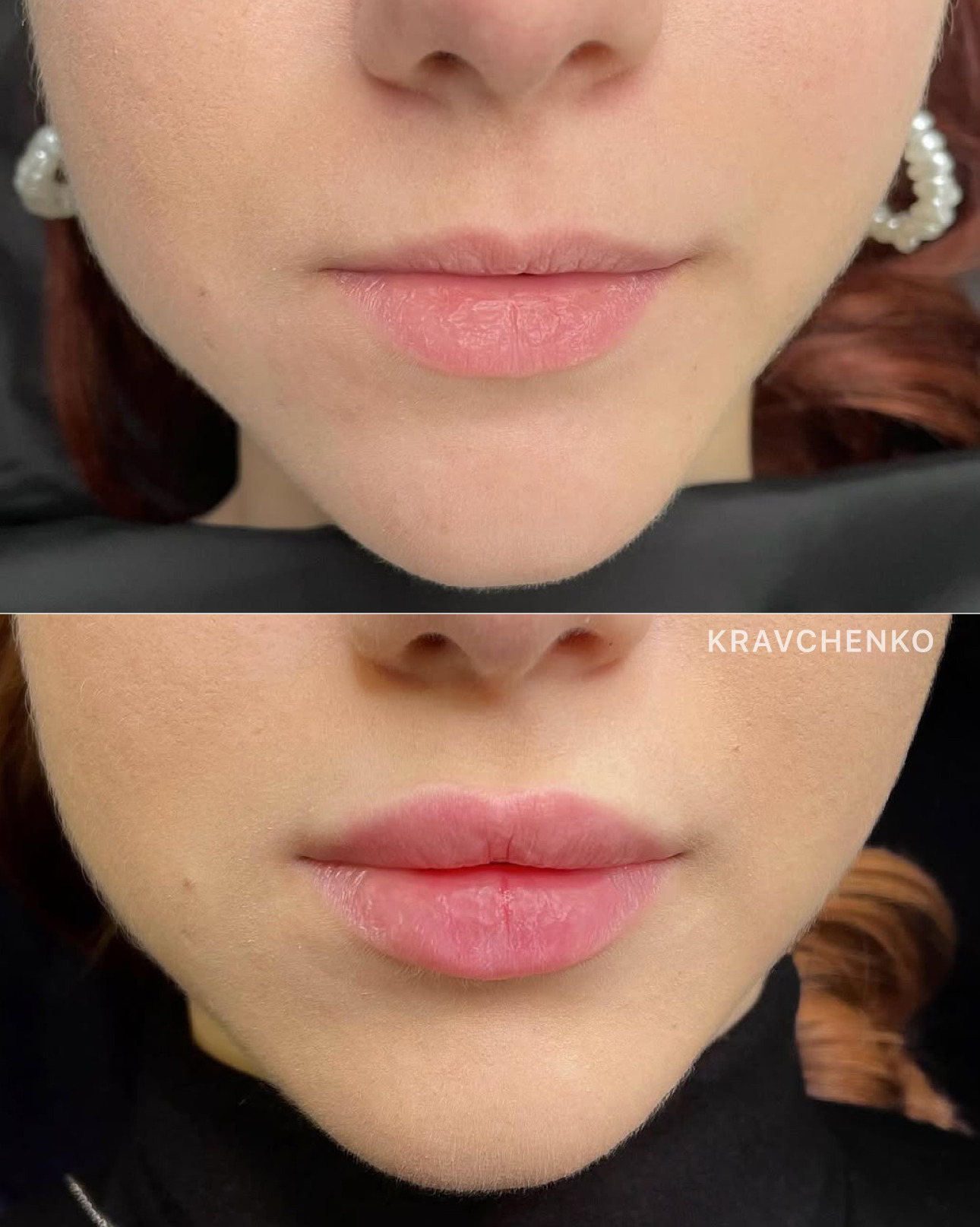 Збільшення губ філером, фото - Врач-косметолог Филипп Кравченко