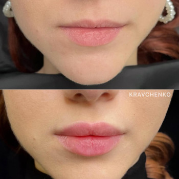 Збільшення губ філером