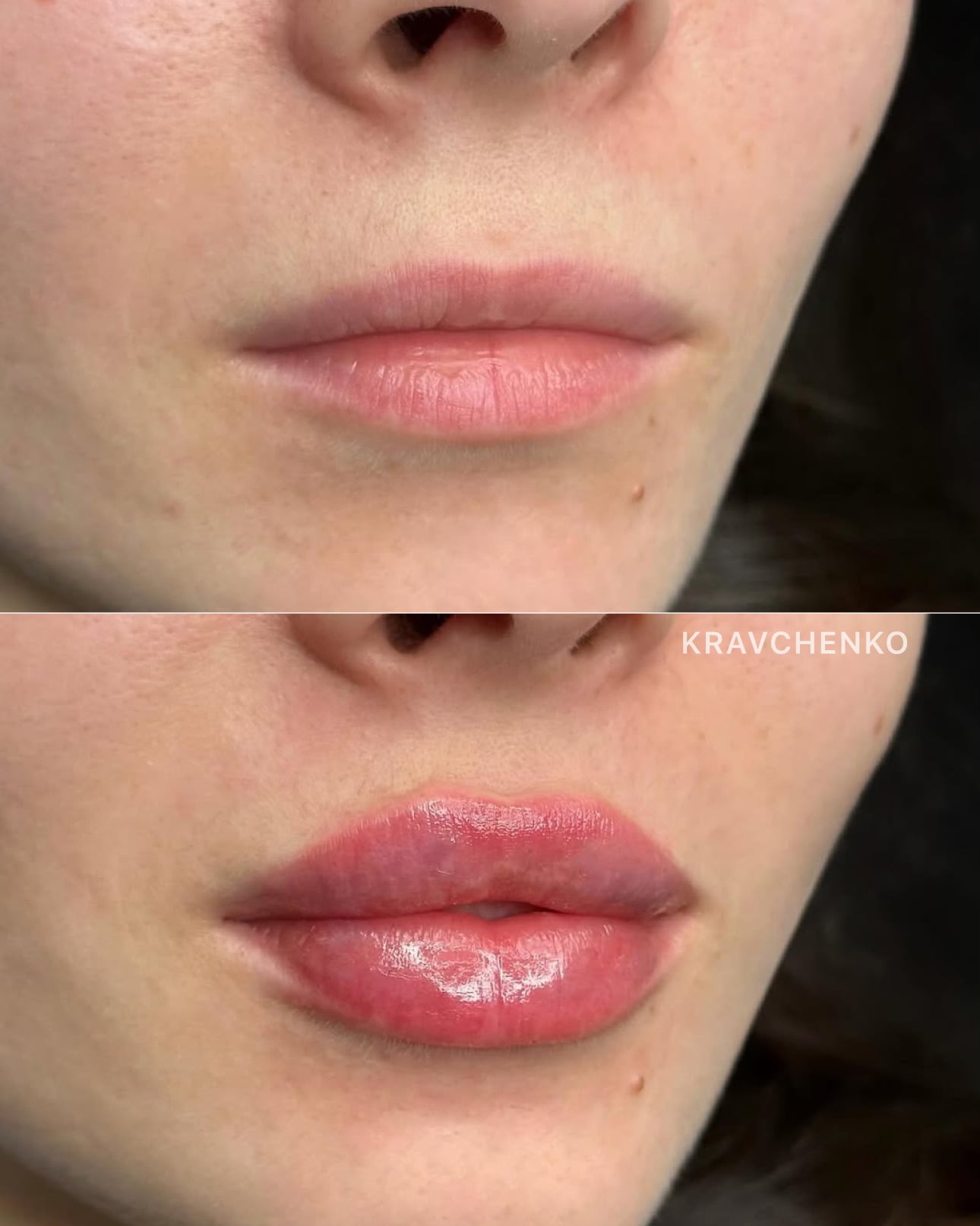 Збільшення губ філером, фото - Врач-косметолог Филипп Кравченко