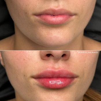 Збільшення губ філером