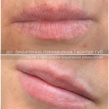 видалення перманенту