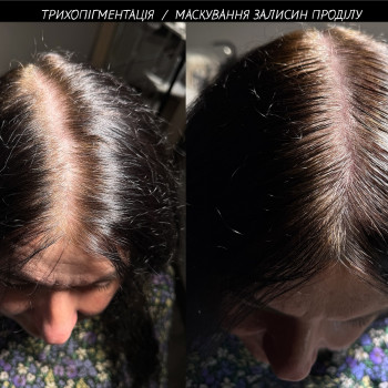 трихопігментація (маскування залисин перманентом)