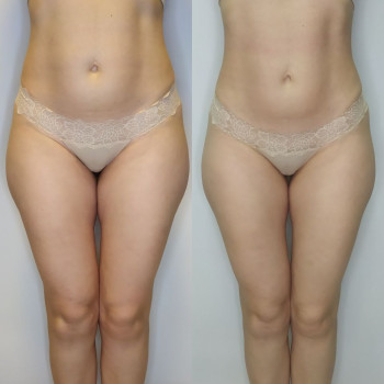 Результат після курсу Endospheres 🔥 Менше целюліту, зменшення об’ємів і помітно краща якість шкіри — більш щільна, гладка та рівна.