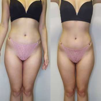 Результат після курсу Endospheres 🔥 Менше целюліту, зменшення об’ємів і помітно краща якість шкіри — більш щільна, гладка та рівна.