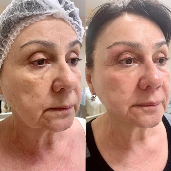 Endospheres обличчя: ліфтинг, тонус і свіжа шкіра без набряків