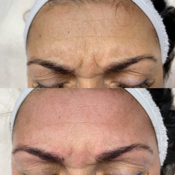 Endospheres обличчя: ліфтинг, тонус і свіжа шкіра без набряків