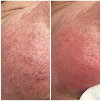 Видалення судин на щоках: результат після процедури Lumenis M22