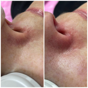 Видалення судин на носі: результат після процедури Lumenis M22