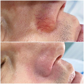 Стан шкіри після видалення судин на носі. Lumenis M22