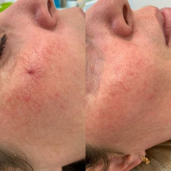 Стан шкіри після видалення судин на щоках. Lumenis M22