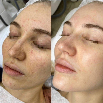 Результат фотоомолодження (IPL терапія). Lumenis M22 ✨