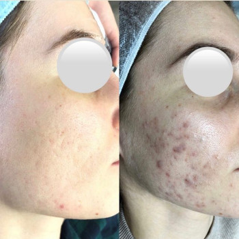 Результат лікування акне. Lumenis M22 ✨
