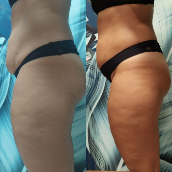 Ефект після Endospheres 🔥 Менше целюліту, чіткіші контури та гладка, щільна шкіра.