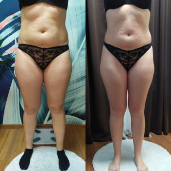 Ефект після Endospheres 🔥 Менше целюліту, чіткіші контури та гладка, щільна шкіра.