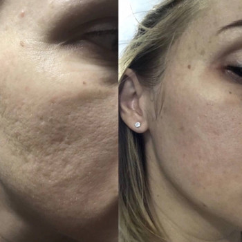 Стан шкіри після шліфування. ResurFX, Lumenis M22