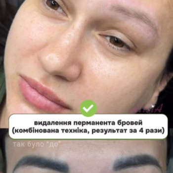 видалення перманенту