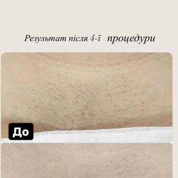 Лазерна епіляція