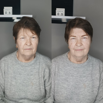 ПМ і цукровий діабет 75+