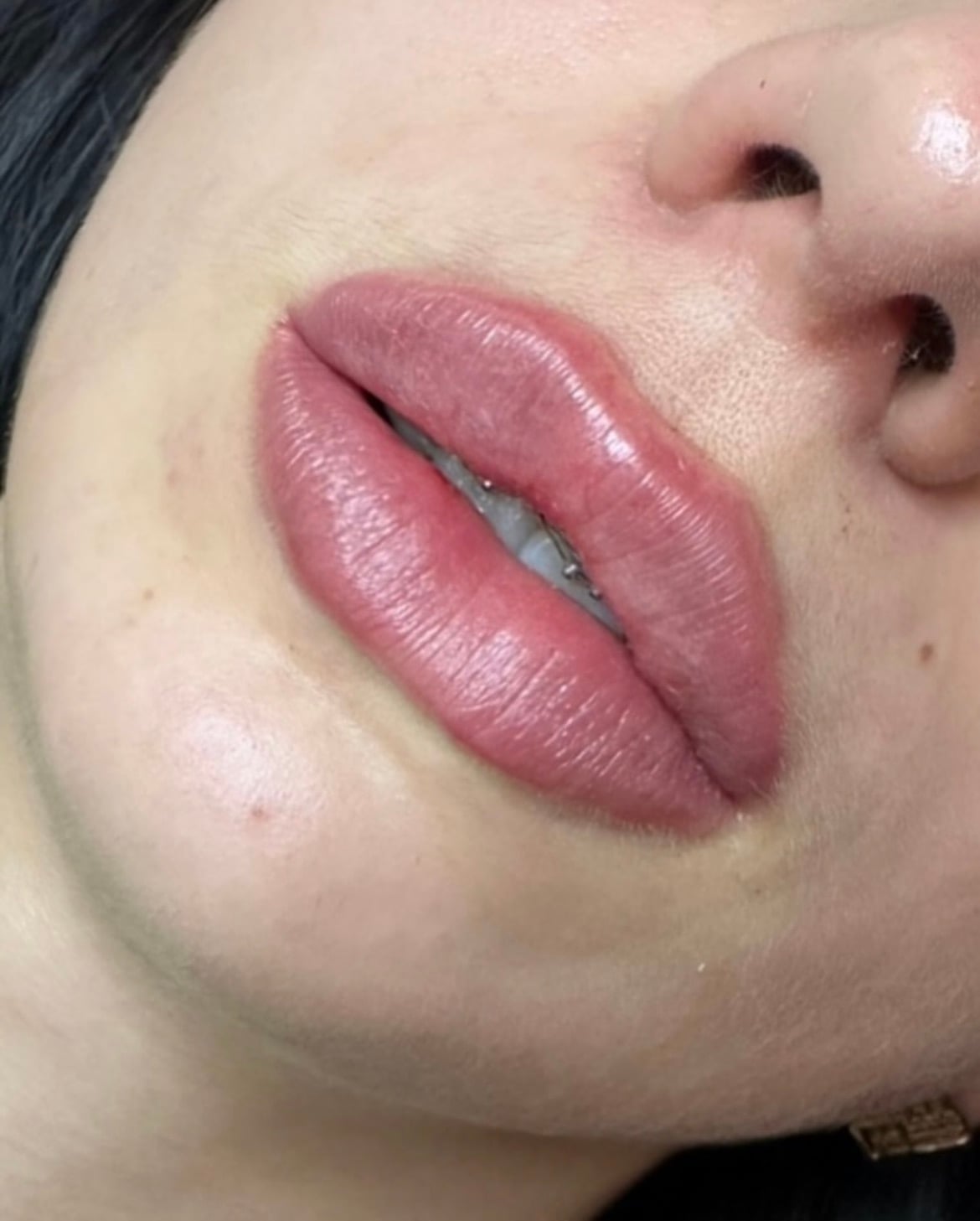 Збільшення губ, фото - Косметолог Ольга Мельник