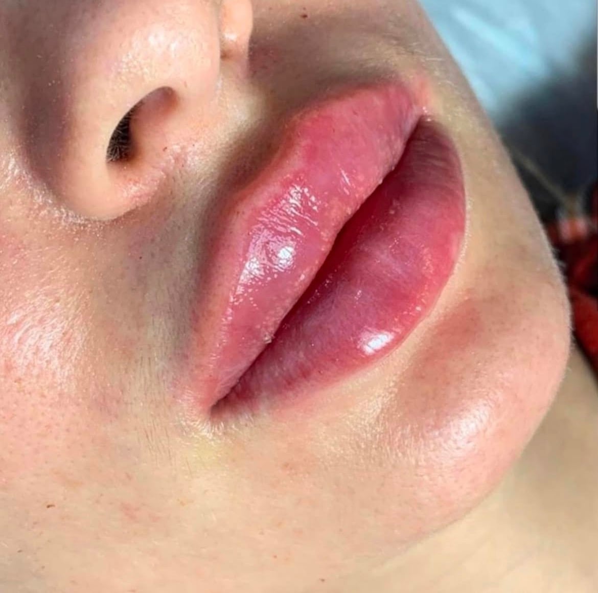 Збільшення губ, фото - Косметолог Ольга Мельник