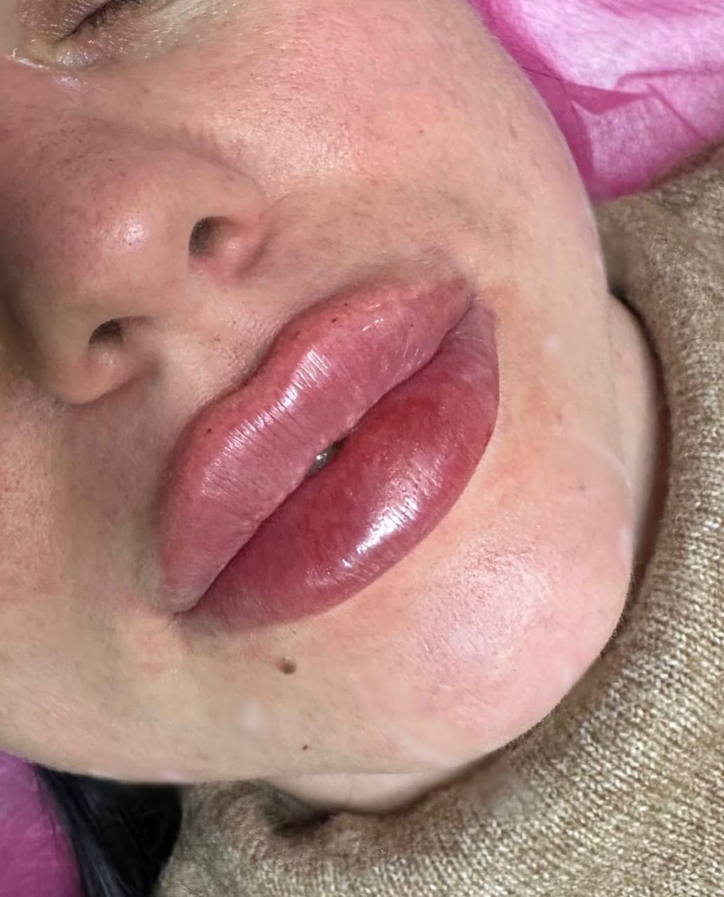 Збільшення губ, фото - Косметолог Ольга Мельник