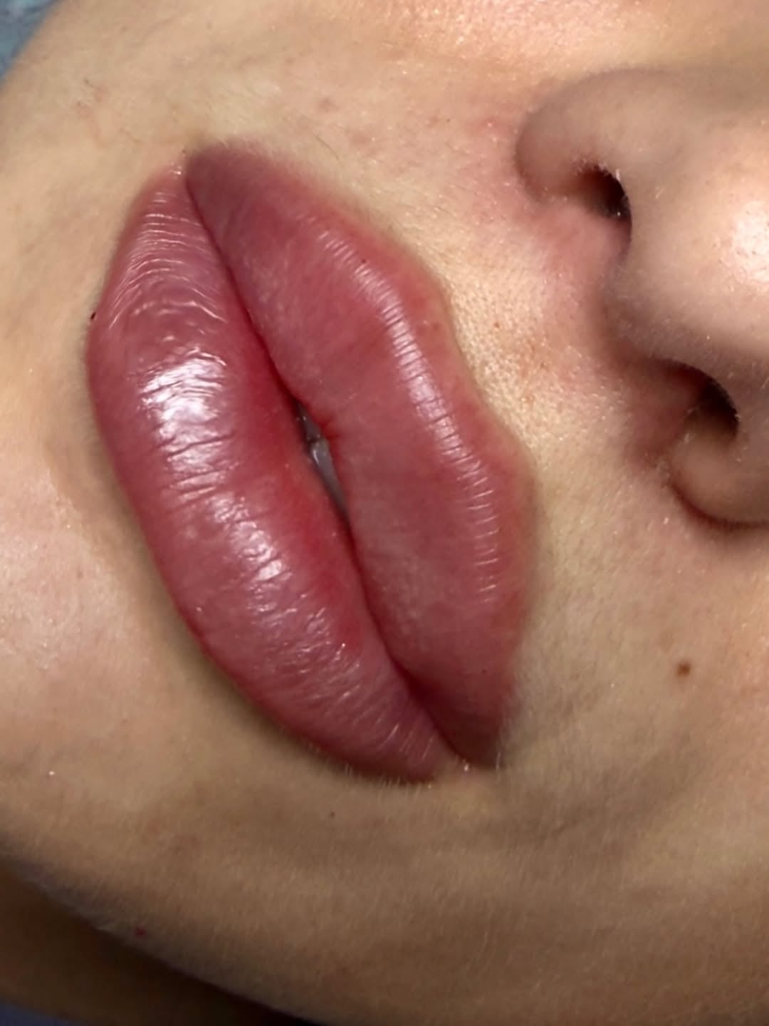 Збільшення губ, фото - Косметолог Ольга Мельник