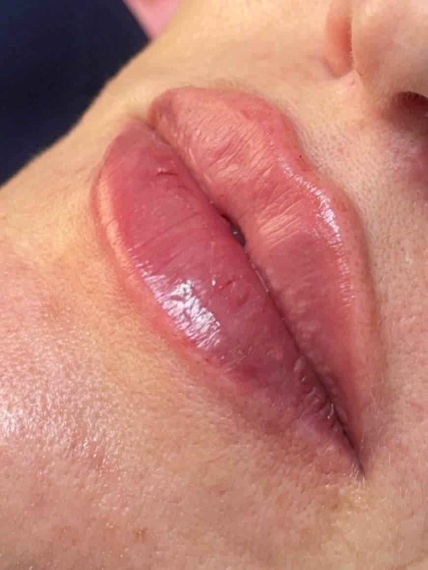 Збільшення губ, фото - Косметолог Ольга Мельник