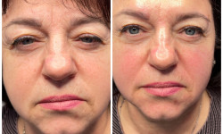 Омолодження Косметолог Оля Біла Церква