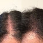 Мезо терапія шкіри голови Мастер татуажа  Кривой Рог