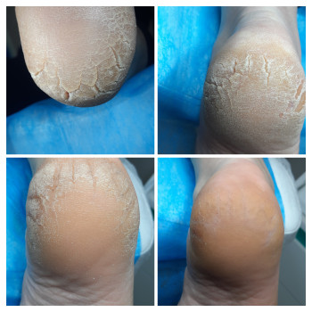 Фото с портфолио ВАШ ПОДОЛОГ Подологический центр Лауры Токаренко