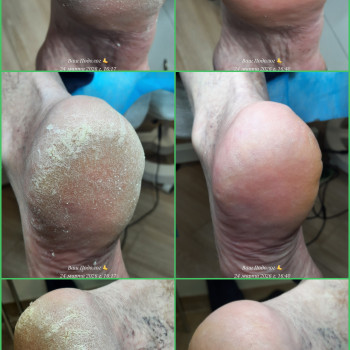 Фото с портфолио ВАШ ПОДОЛОГ Подологический центр Лауры Токаренко