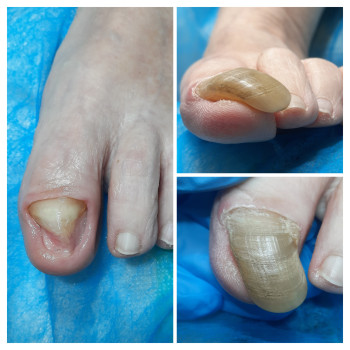 Фото с портфолио ВАШ ПОДОЛОГ Подологический центр Лауры Токаренко