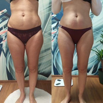 Ефект після Endospheres. Менше об’ємів, більш гладка й щільна шкіра, целюліт згладжений.