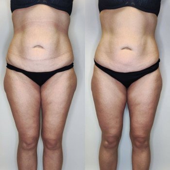 Ендосфера: після курсу. Менше нерівностей, більше тонусу та щільності.