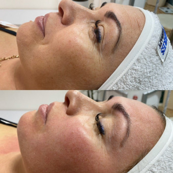 Endospheres обличчя: ліфтинг, тонус і свіжа шкіра без набряків