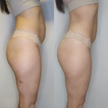 Після Endospheres 🔥 Шкіра рівніша й щільніша, об’єми менші, целюліт менш помітний.