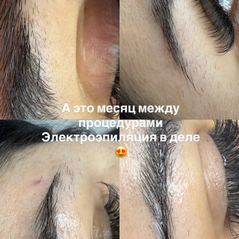 Електроепіляція у дії