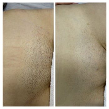 Лазерна епіляція у дії