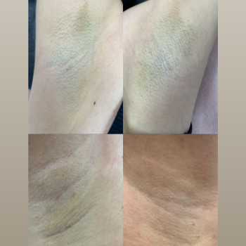 Динаміка лазерноії епіляції