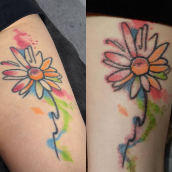 До та одразу після видалення тату