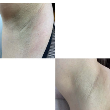 Лазерна епіляція 1 процедура