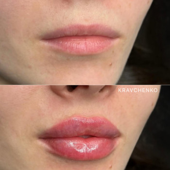 Збільшення губ гіалуроновою кислотою