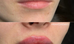 Увеличение губ гиалуроновой кислотой Врач-косметолог Филипп Киев