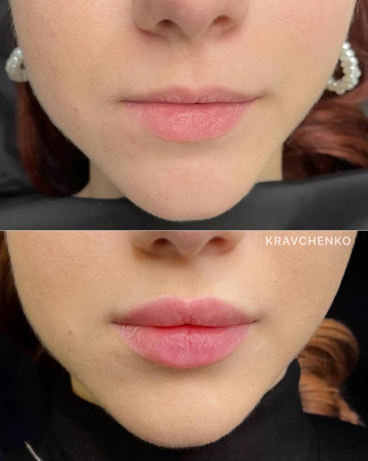 Збільшення губ гіалуроновою кислотою, фото - Врач-косметолог Филипп Кравченко