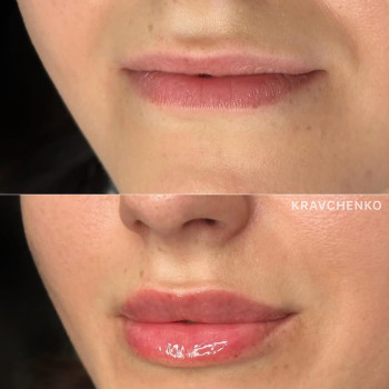 Збільшення губ гіалуроновою кислотою