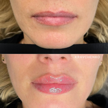 Збільшення губ гіалуроновою кислотою