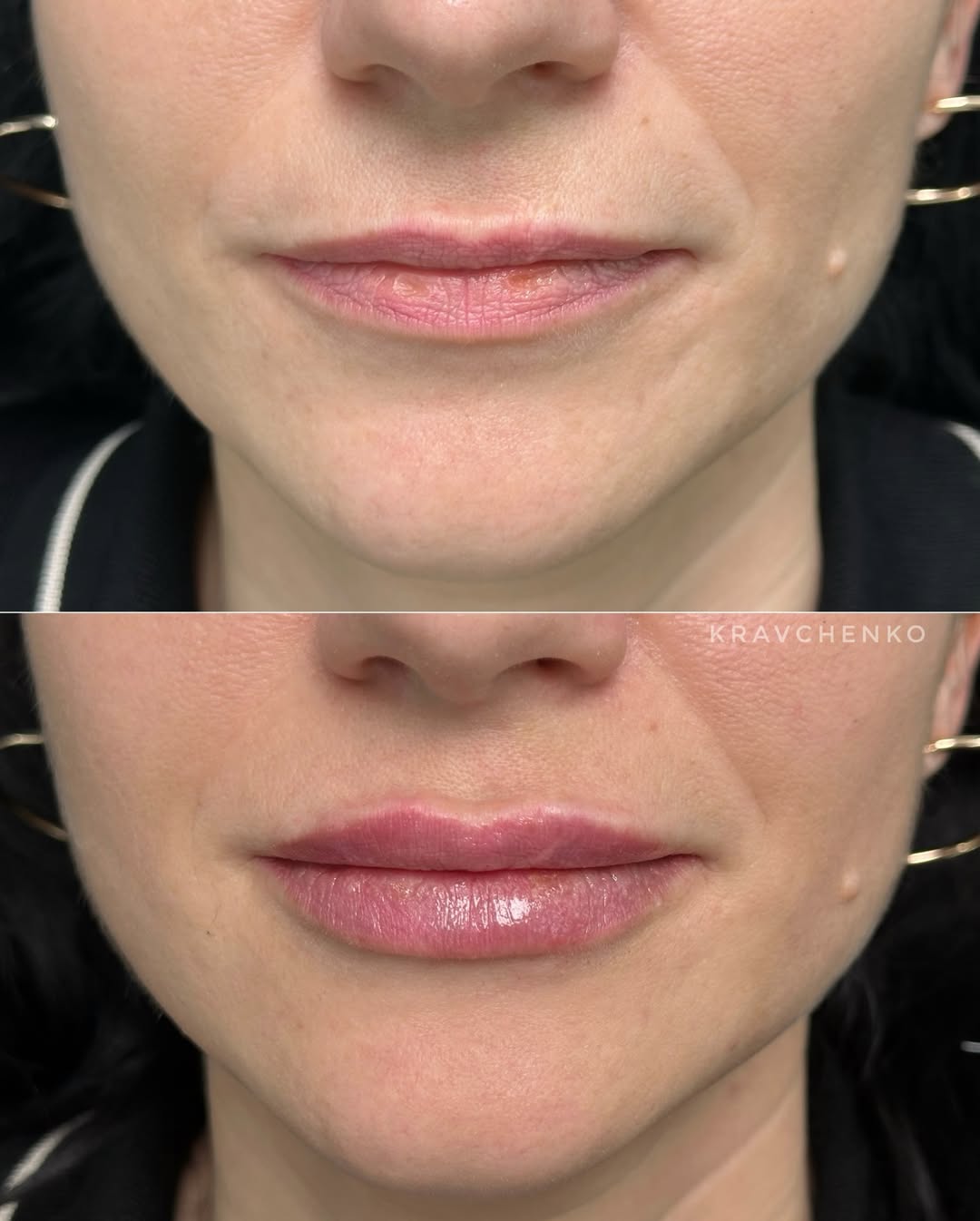 Збільшення губ гіалуроновою кислотою, фото - Врач-косметолог Филипп Кравченко